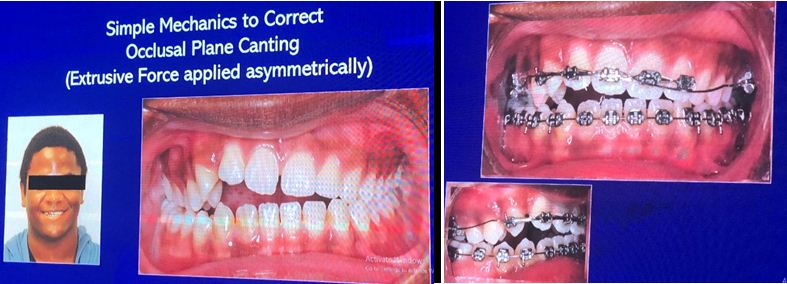 Sử dụng cung đảo ngược để sửa chữa nghiêng mặt phẳng cắn